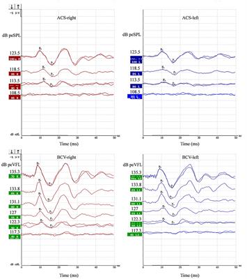 Effects of aging on ocular vestibular-evoked myogenic potential using ER-3A insert earphone and B81 bone vibrator